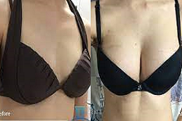 Areola Reduction Clinic in Abui Dhabi