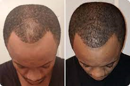 Baldnes Tretament for male in Abu Dhabi & Al Ain