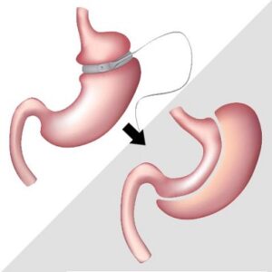 Blog 1 Bariatric Surgery Cost in Abu Dhabi Al Ain Price in UAE