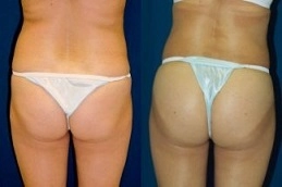 Before-After-French-butt-reshaping-in-Abu-Dhabi