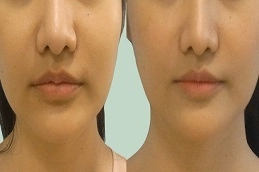 Before-After-Lip-Reduction-Surgery-in-Abu-Dhabi-Al-Ain