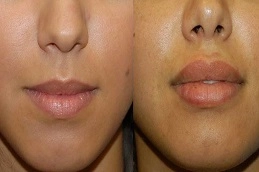 Before-After-Lip-Reduction-Surgery-in-Abu-Dhabi