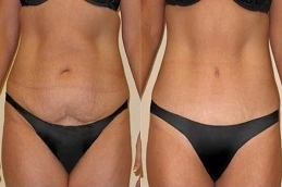 Before-After-Mini-Abdominoplasty-in-Abu-Dhabi-Al-Ain
