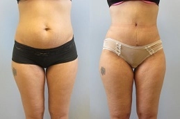 Before-After-Mini-Abdominoplasty-in-Abu-Dhabi