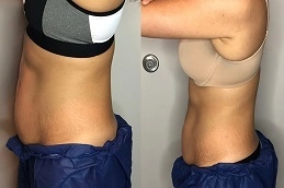 Before-After-Vaser-4D-Liposuction-in-abu-Dhabi-Al-Ain