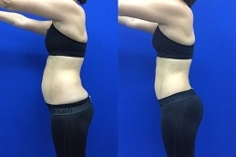 Before-After-Vaser-4D-liposuction-in-Abu-Dhabi