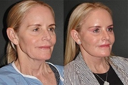 Before-After-Vector-Facelift-in-Abu-Dhabi