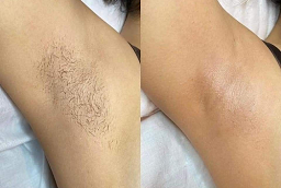 Before and After Electrolysis Laser Hair Removal