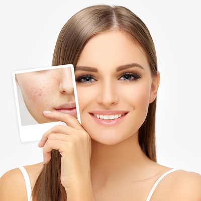 Best Acne Scar Treatment in Abu Dhabi & Al Ain Scars Removal Cost