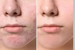 Best-Acne-Treatment-Clinic-in-Abu-Dhabi-Al-Ain