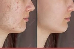 Best-Acne-Treatment-in-Abu-Dhabi