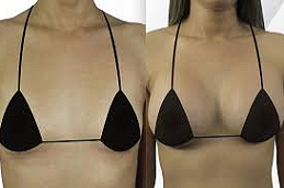 Best Breast Augmentation in Abu Dhabi