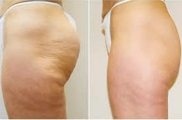 Best Cellulite Removal Treatment Abu DHbai UAE
