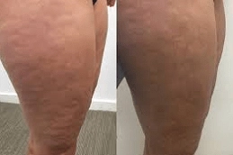Best Cellulite Removal Treatment Abu DHbai