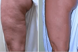 Cellulite Removal Treatment 8 Best Cellulite Removal Treatment