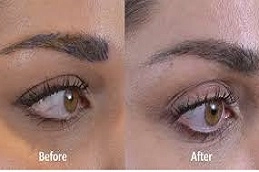 Best-Clinic-For-Eylash-Hair-Transplant