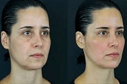 Best-Clinic-for-Hyaluronic-Acid-Injections-in-Abu-Dhabi