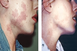 Birthmarks Removal Treatment 5 Best-Clinic-for-Laser-Birthmark-Removal-in-Abu-Dhabi