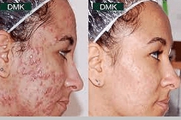 Best-DMK-Enzymatic-Treatment-in-Abu-Dhabi