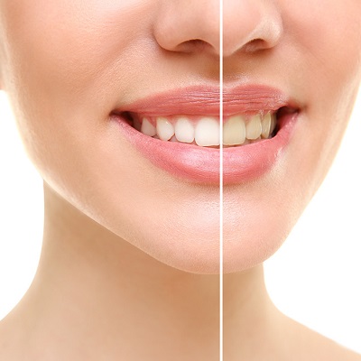 Best Dental Stains Removal in Abu Dhabi