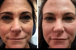 Best-Dermapen-treatment-in-Abu-Dhabi-Al-Ain