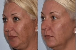 Best-Diamond-Peels-Clinic-in-Abu-Dhabi-Al-Ain