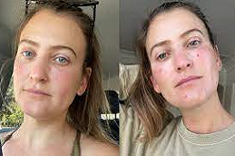 Best-Facial-Capillaries-Treatment-in-Abu-Dhabi-Al-Ain