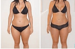 Best Fat Reduction Clinic in Abu Dhabi