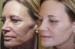 Best-Fotona-Twin-Light-Fractional-Rejuvenation-in-Abu-Dhabi UAE