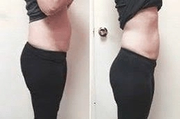 Best-GPS-Laser-Liposuction-in-Abu-Dhabi-Al-Ain-Clinic