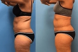 Best-GPS-Laser-Liposuction-in-Abu-Dhabi-Al-Ain