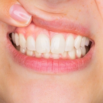 Gingivitis Treatment 2 Best Gingivitis Treatment in Abu Dhabi & Al Ain