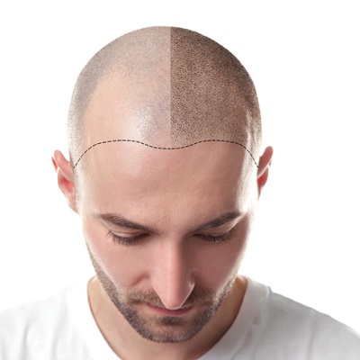 Best Hair Plantation in Abu Dhabi Al Ain Hair Plantation Cost