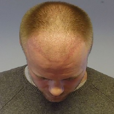 Best Hair Restoration Clinic In Abu Dhabi Al Ain Clinic