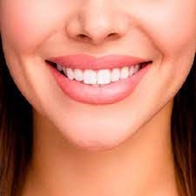 Hollywood Smile Makeover 2 Best Hollywood Smile Makeover in Abu Dhabi & Al Ain Smile Makeover Cost