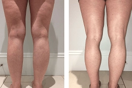 Best-J-Plasma-for-Thighs-and-Arms-in-Abu-Dhabi-Al-Ain-Clinic