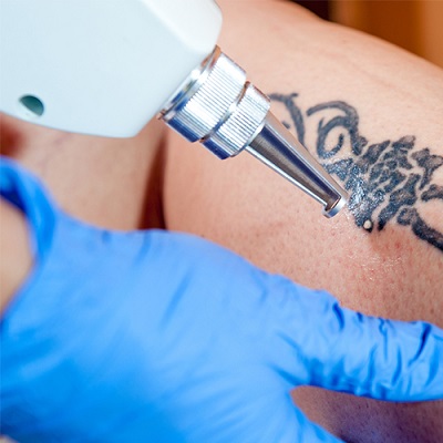 Want to visit Laser Tattoo Removal Specialist in Wakad, Hinjewadi, Pimpri  Chinchwad? Dr Aishwarya Patil is the Best Laser Tattoo Removal Specialist  in Wakad, Hinjewadi, Pimpri Chinchwad and Pune. Lasers remove tattoos