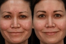 Best MESOGOLD Stamp Therapy in Abu Dhabi