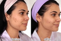 Microneedling for Acne Scars 4 Best-Microneedling-for-Acne-Scars-in-Abu-Dhabi-Al-Ain