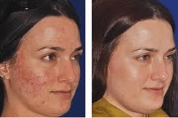 Microneedling for Acne Scars 5 Best-Microneedling-for-Acne-Scars-in-Abu-Dhabi