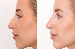 Liquid Rhinoplasty 5 Best-Non-Surgical-Nose-Job-Clinic-in-Abu-Dhabi