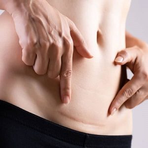 Laser Scar Removal 2 Best Scar Removal in Abu Dhabi