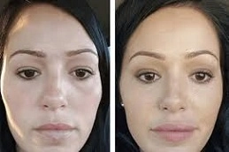 Best-Under-Eye-Fillers-Clinic-in-Abu-Dhabi-Al-Ain.