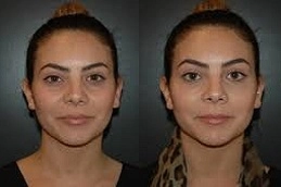 Best-Under-Eye-Fillers-in-Abu-Dhabi.