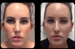 Best-Volift-Fillers-in-Abu-Dhabi