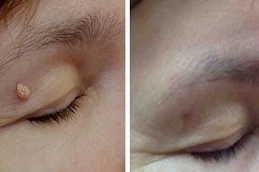 Best-Warts-Removal-in-Abu-Dhabi