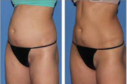 Body Countring in Abu Dhabi