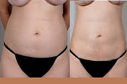 Body tite Liposuction in Abu Dhabi & Al Ain