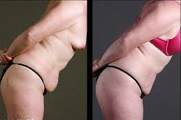 Body tite Liposuction in Abu Dhabi