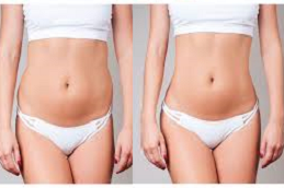 Body tite Liposuction